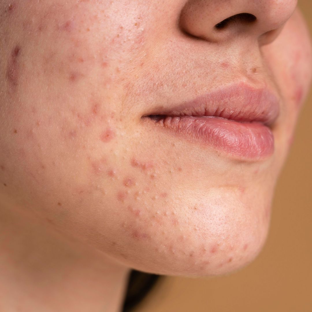 Acne Skin