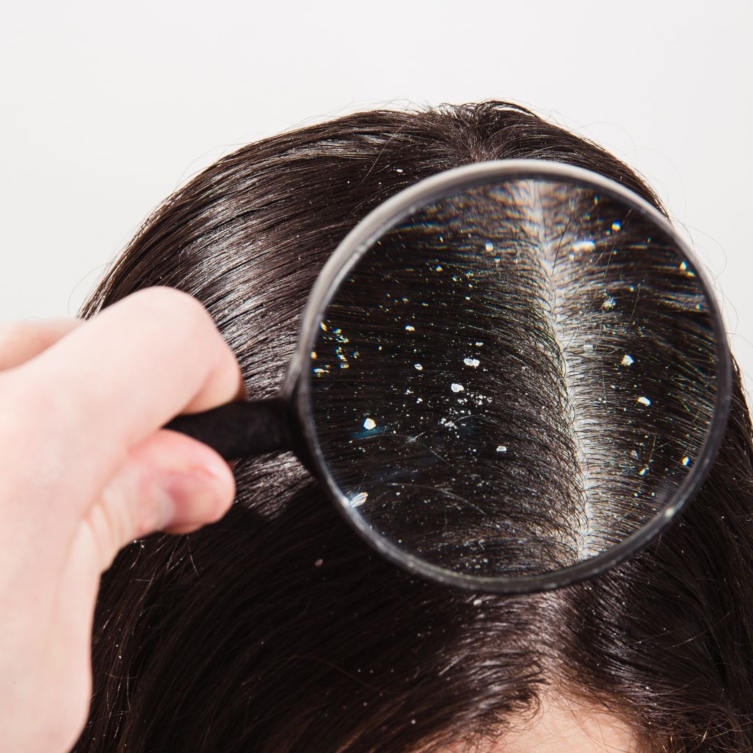 Dandruff